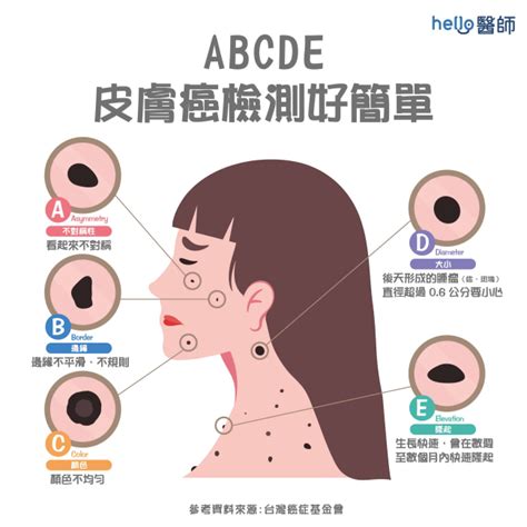 痣變大變凸|痣變大、痣多或長毛會變皮膚癌？認識痣的形成與原因